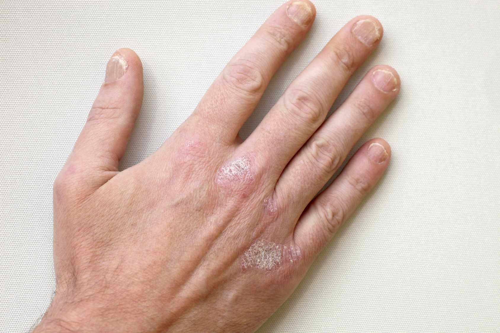 Псориаз на руках: симптомы и лечение