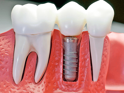 Безоперационная имплантация зубов — достоинства, показания, технология проведения