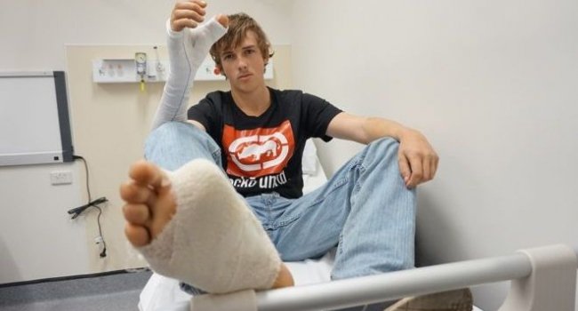 Австралийцу пересадили большой палец с ноги на руку